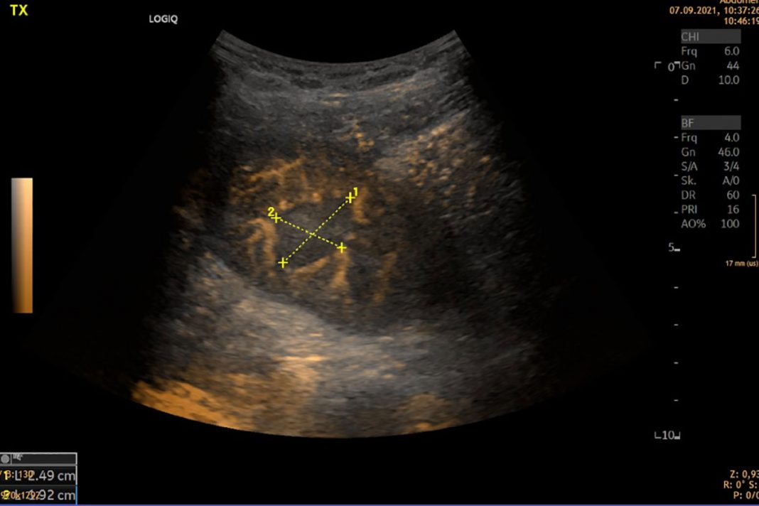 Assessing Function and Structure: Kidney Scan Ultrasound Explained